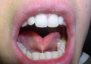 tongue-tie can affect your milk suply